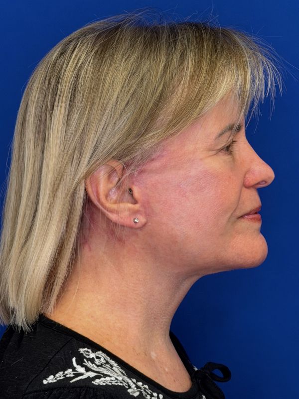 Facelift Before & After Image