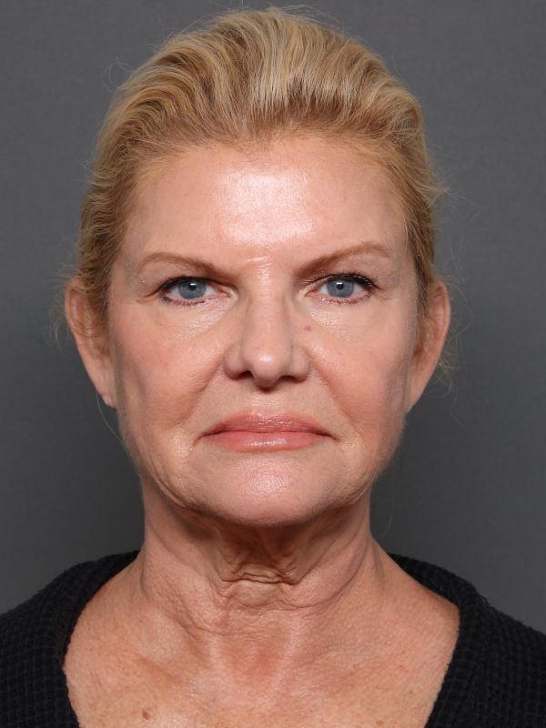 Facelift Before & After Image