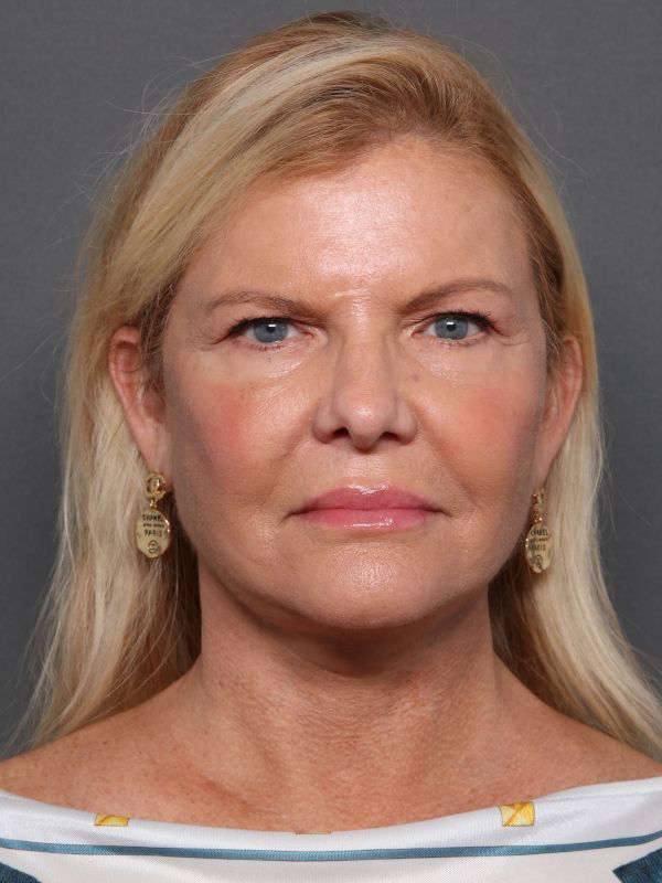 Facelift Before & After Image