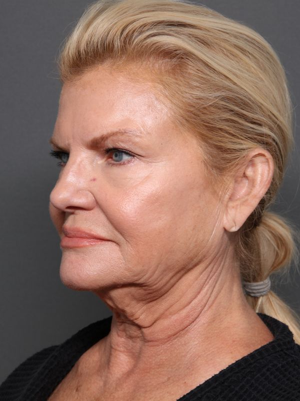 Facelift Before & After Image
