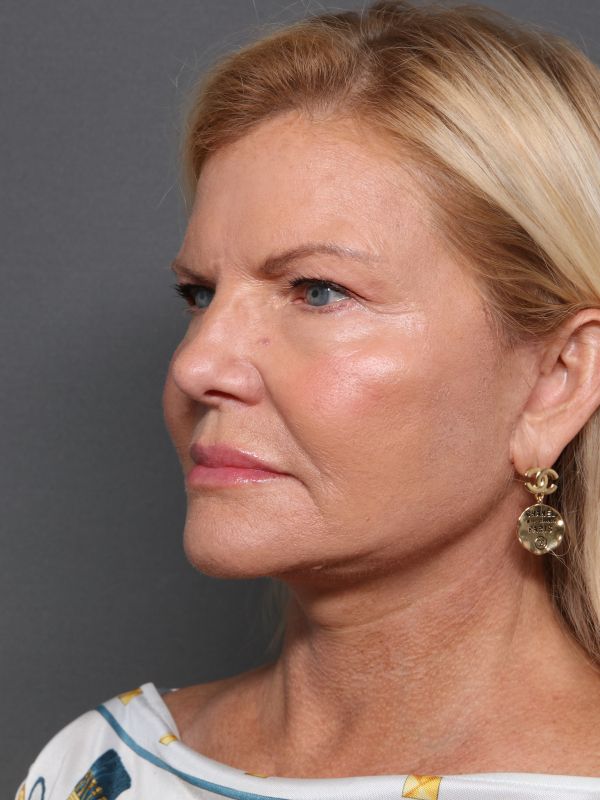 Facelift Before & After Image