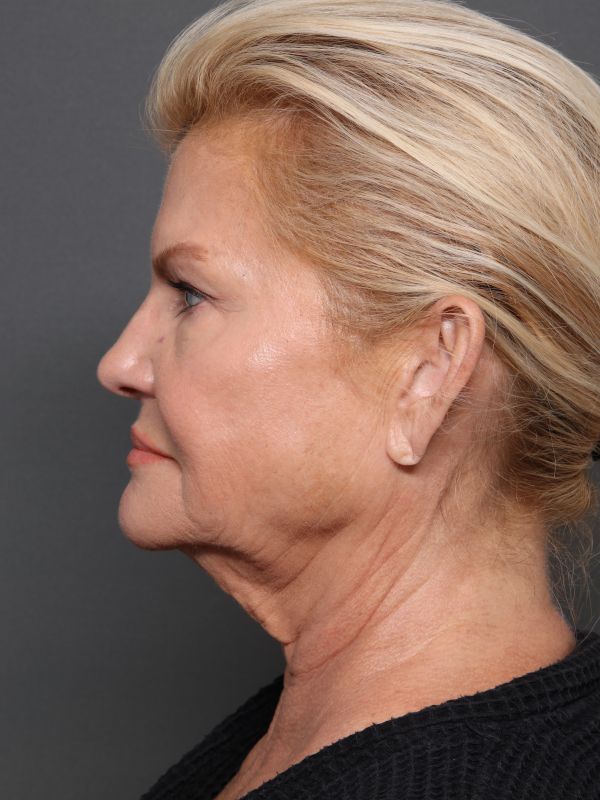 Facelift Before & After Image