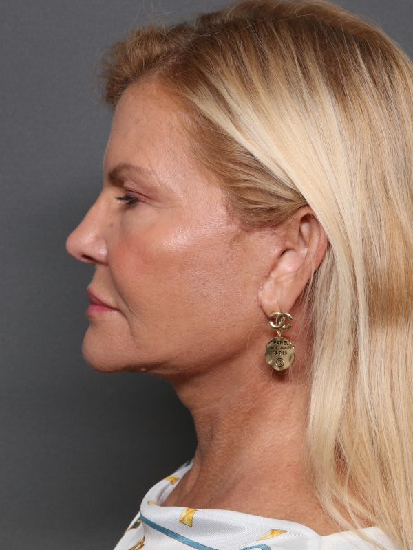 Facelift Before & After Image