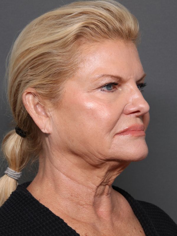 Facelift Before & After Image