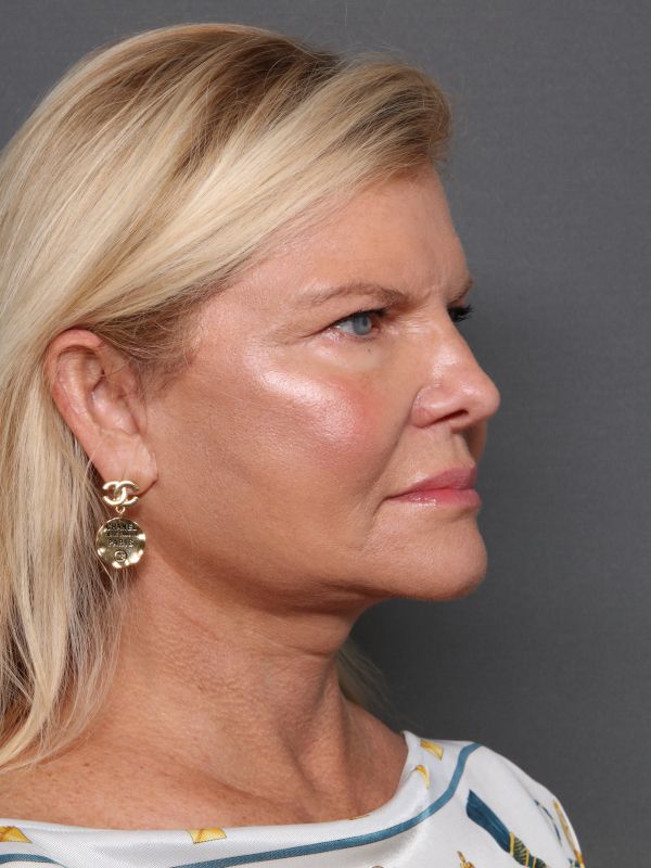 Facelift Before & After Image