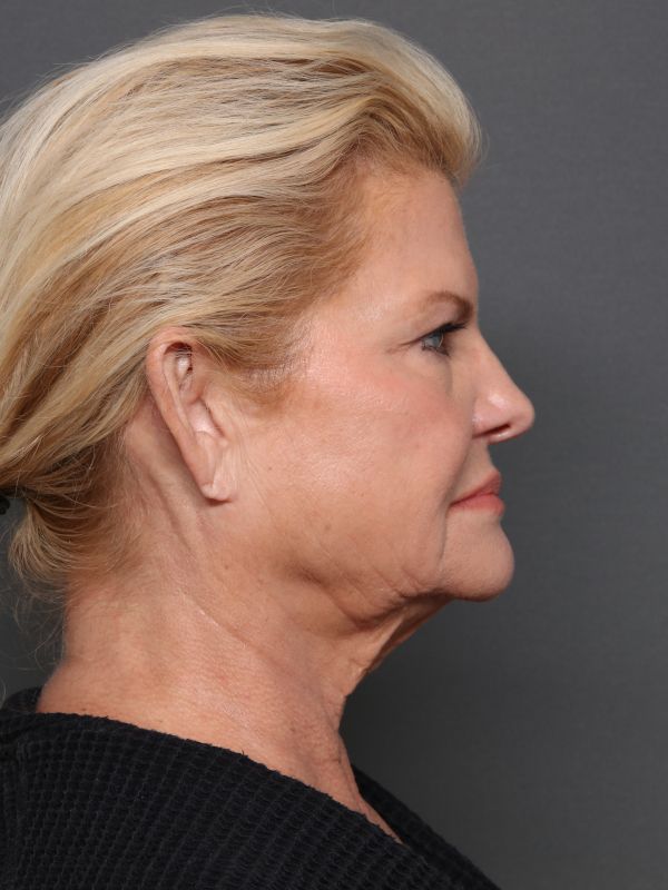Facelift Before & After Image