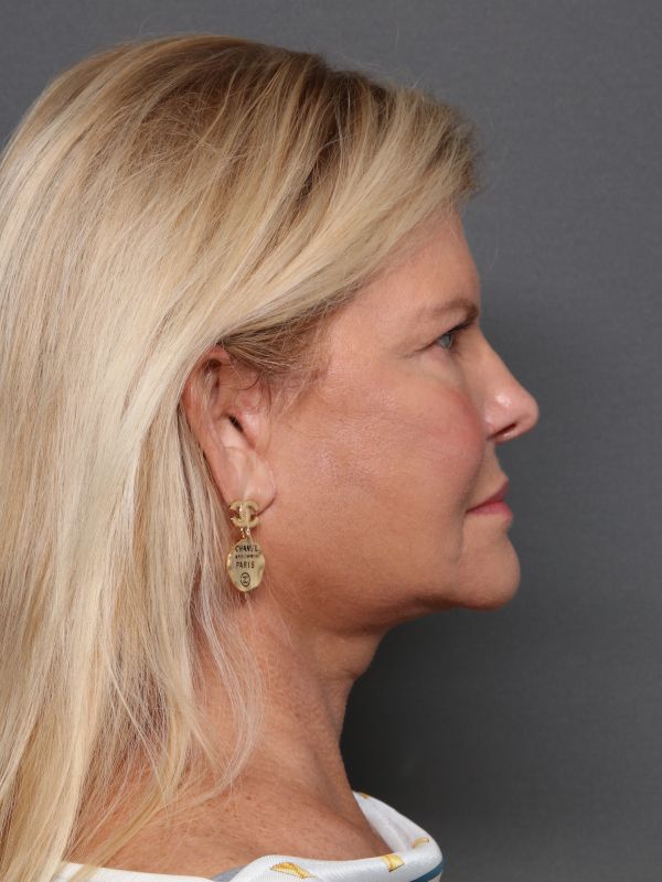 Facelift Before & After Image