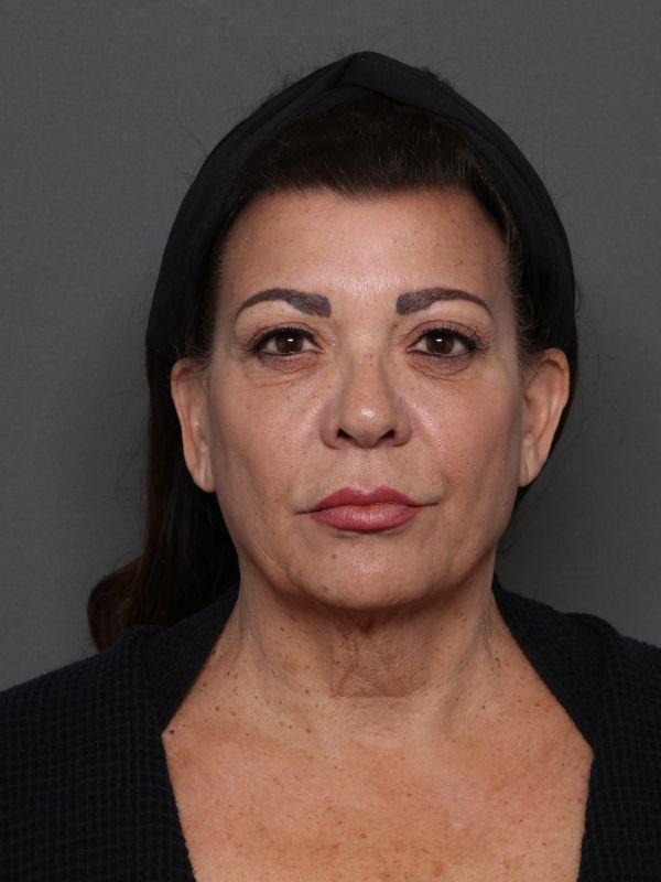 Facelift Before & After Image