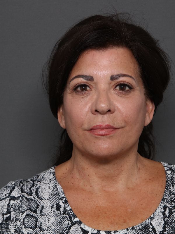 Facelift Before & After Image