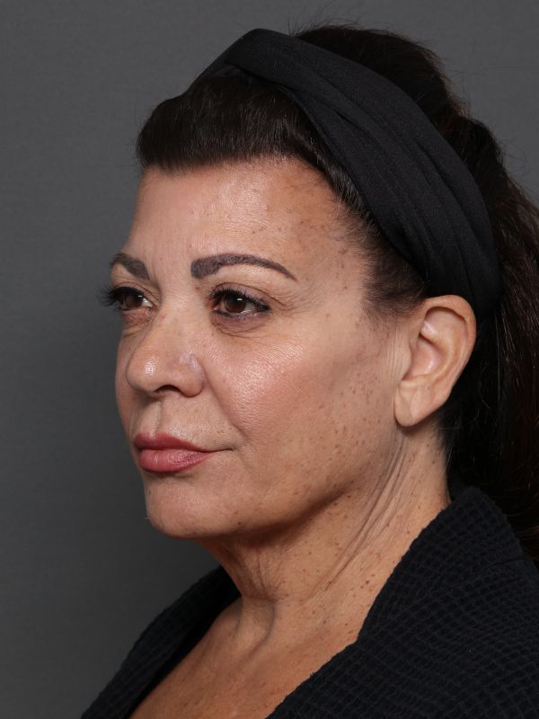 Facelift Before & After Image