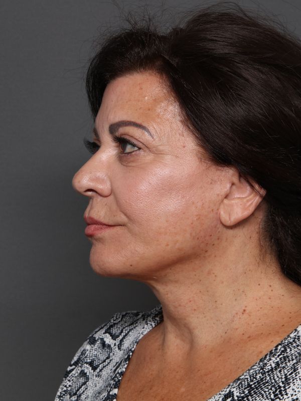 Facelift Before & After Image