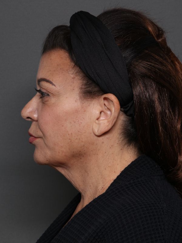 Facelift Before & After Image