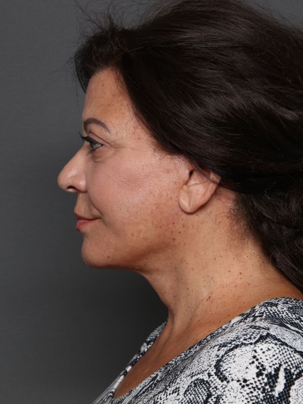 Facelift Before & After Image