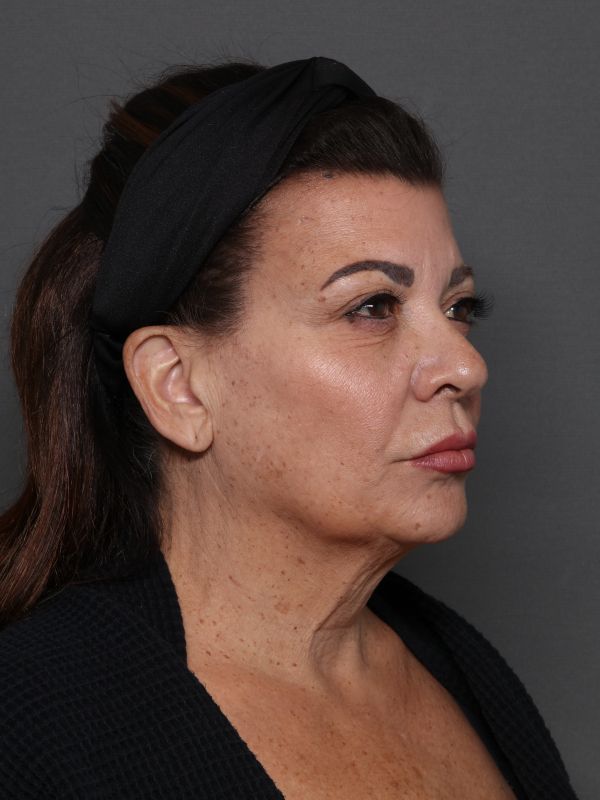 Facelift Before & After Image