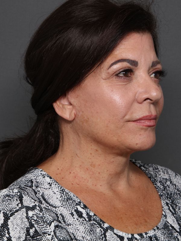 Facelift Before & After Image