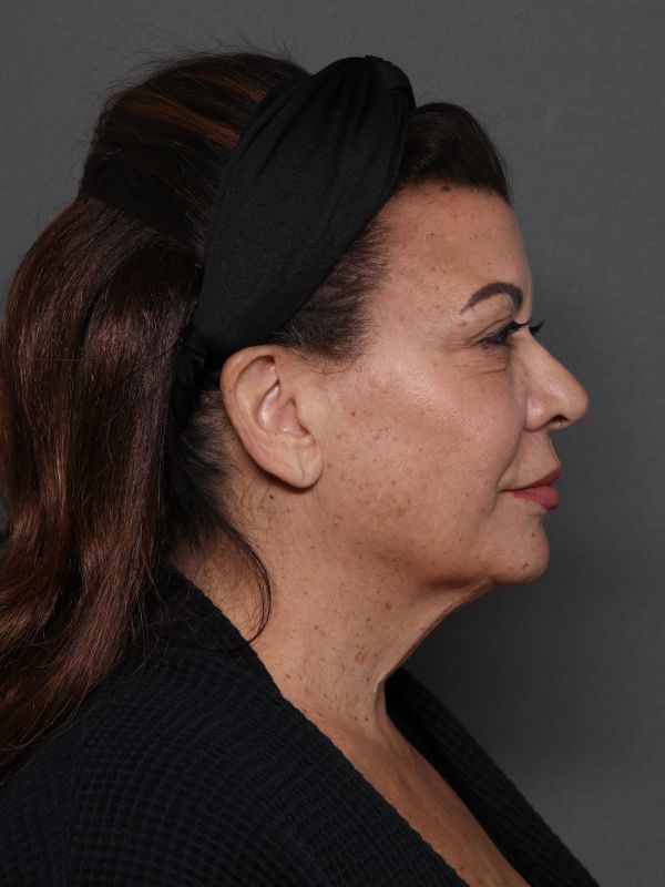 Facelift Before & After Image