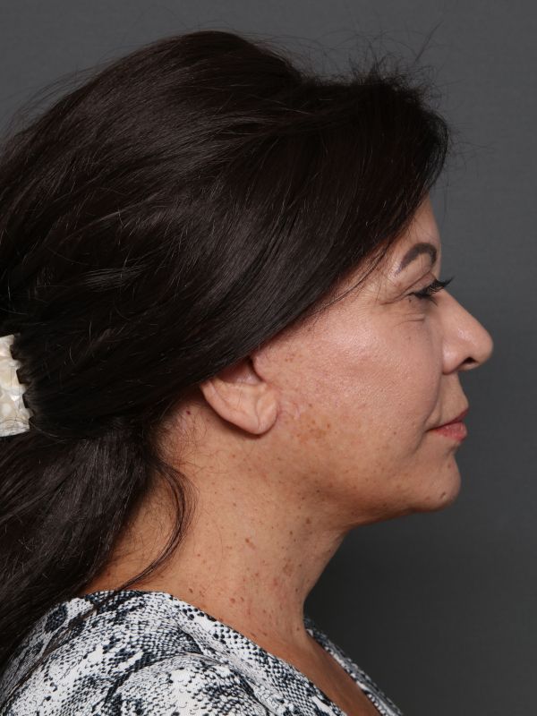 Facelift Before & After Image