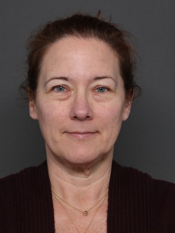 Facelift Before & After Image