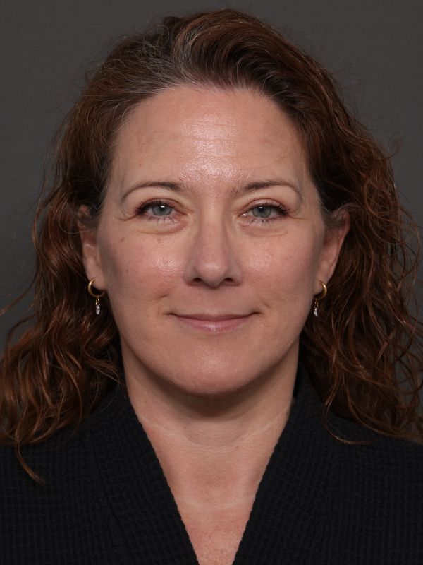 Facelift Before & After Image