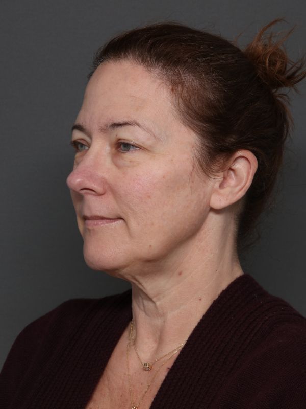 Facelift Before & After Image