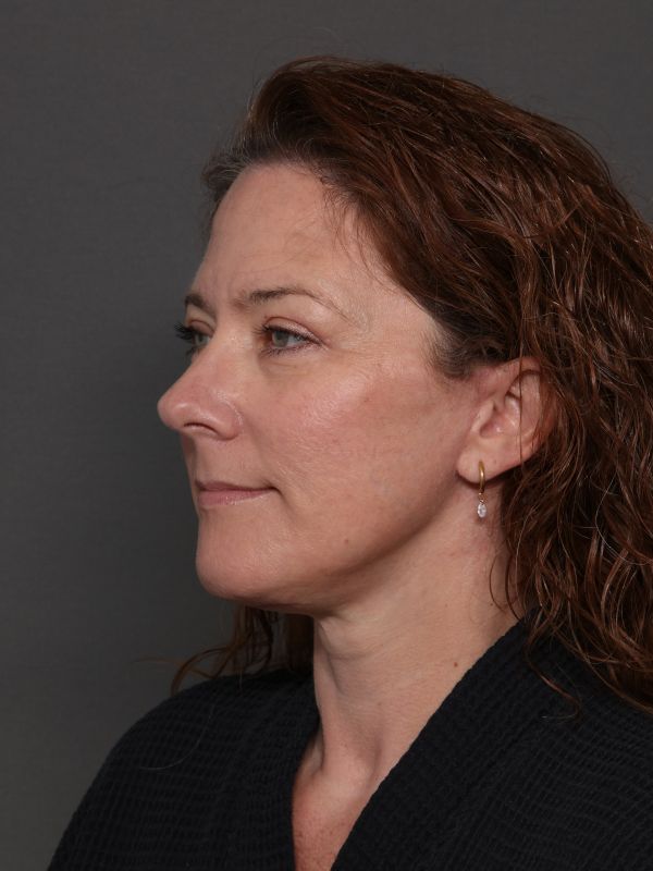 Facelift Before & After Image