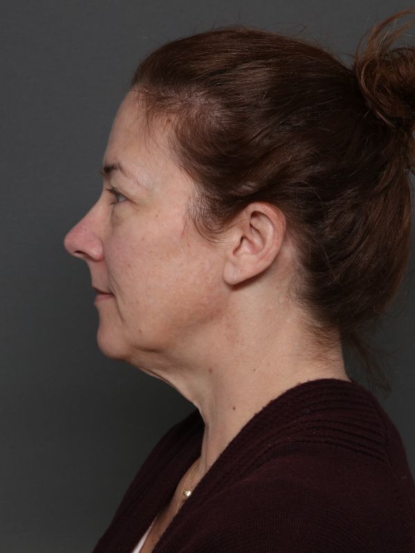 Facelift Before & After Image