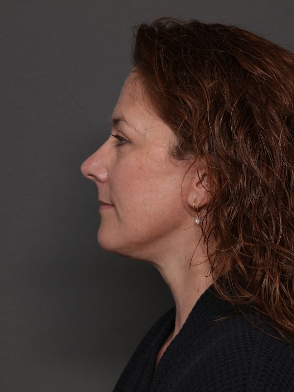 Facelift Before & After Image