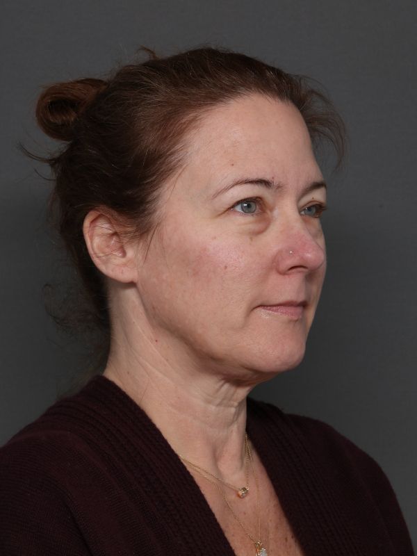 Facelift Before & After Image