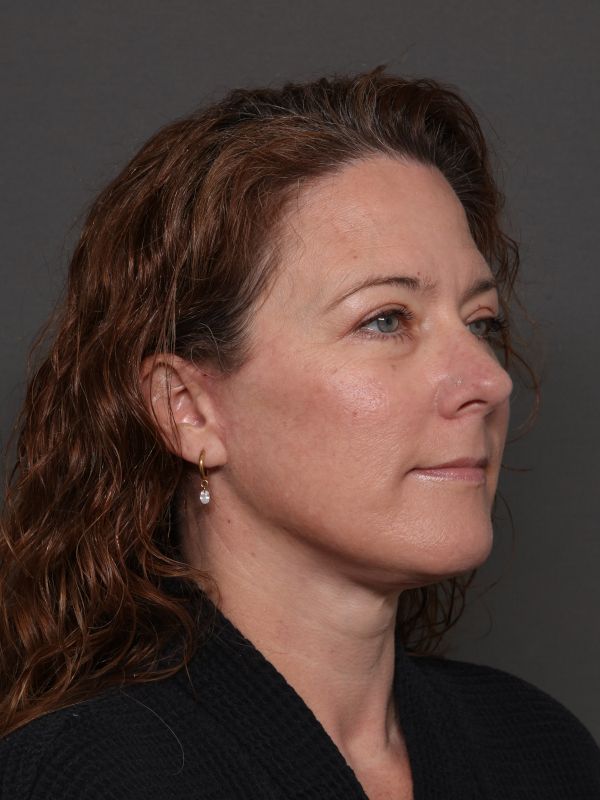 Facelift Before & After Image