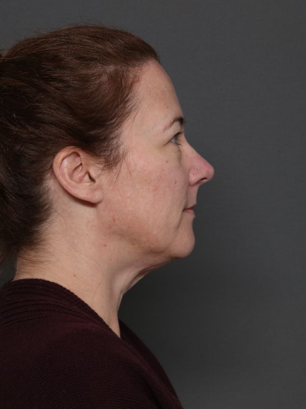 Facelift Before & After Image