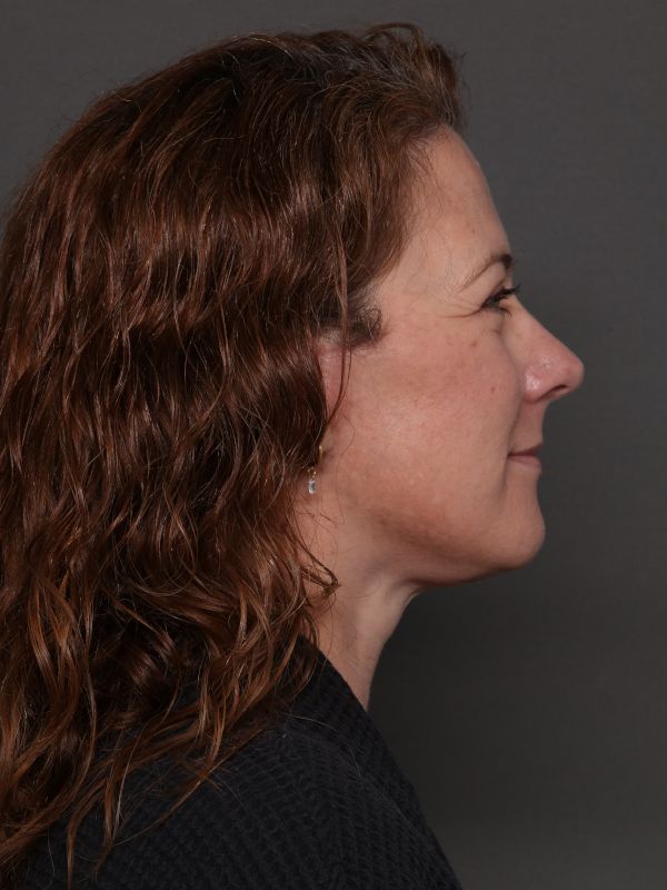 Facelift Before & After Image