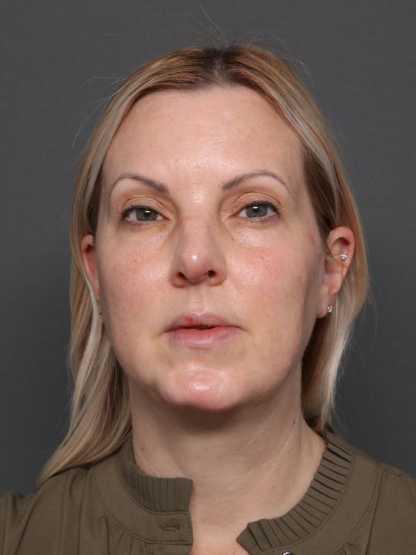 Facelift Before & After Image