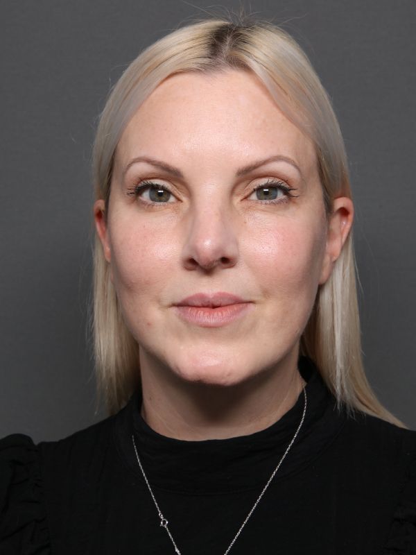 Facelift Before & After Image