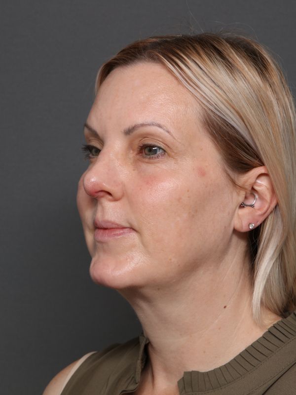 Facelift Before & After Image
