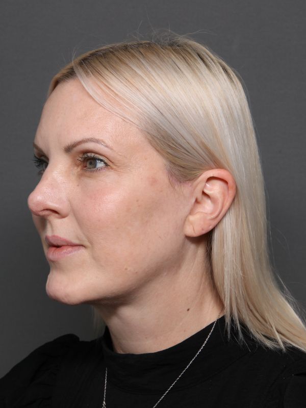 Facelift Before & After Image