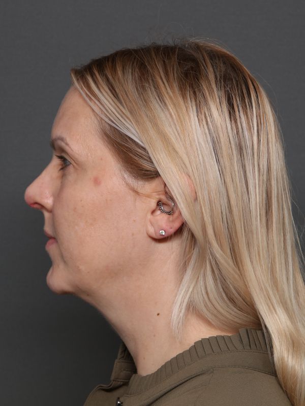 Facelift Before & After Image