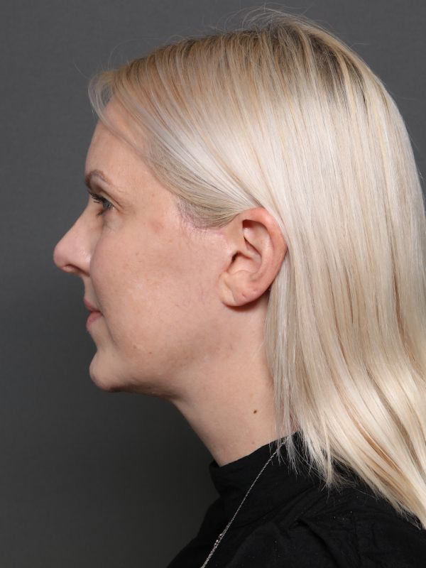Facelift Before & After Image