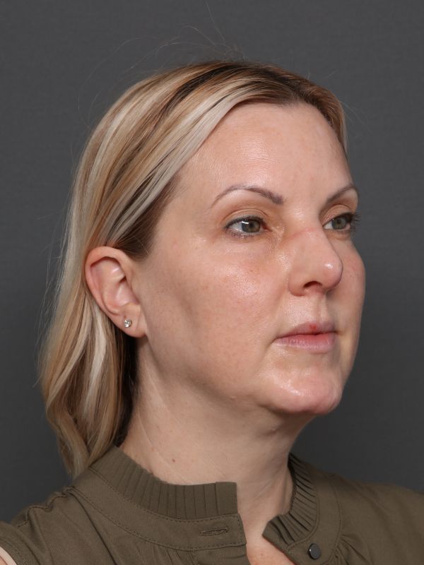 Facelift Before & After Image