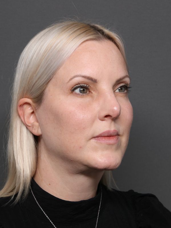 Facelift Before & After Image