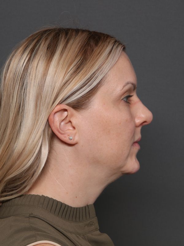 Facelift Before & After Image