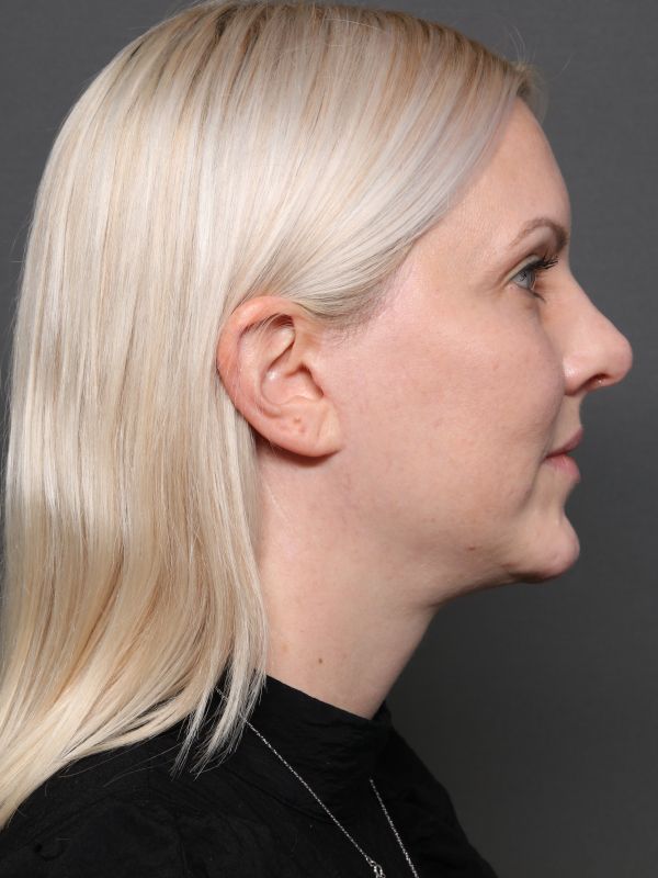 Facelift Before & After Image