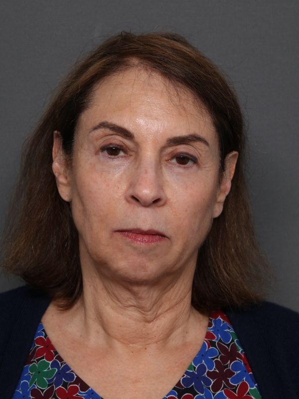 Facelift Before & After Image