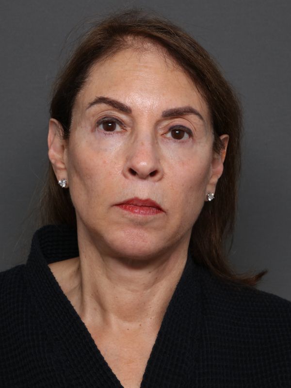 Facelift Before & After Image