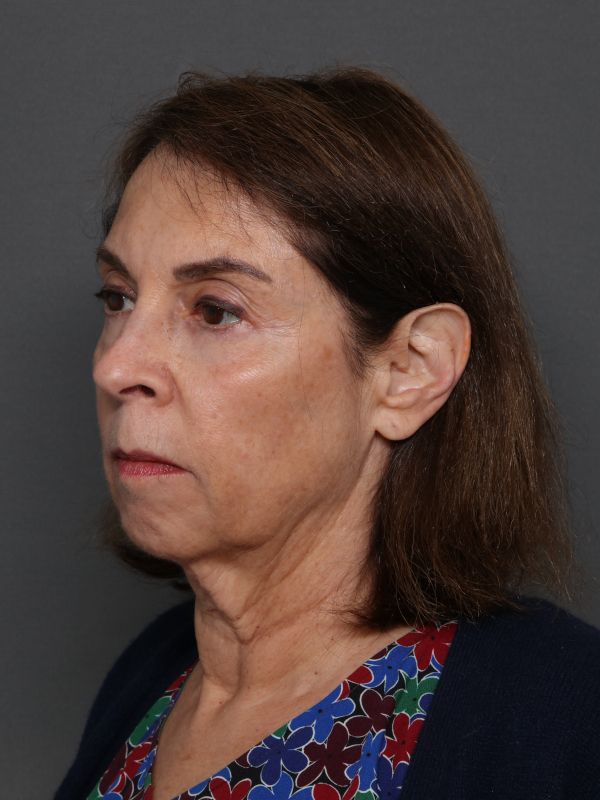 Facelift Before & After Image
