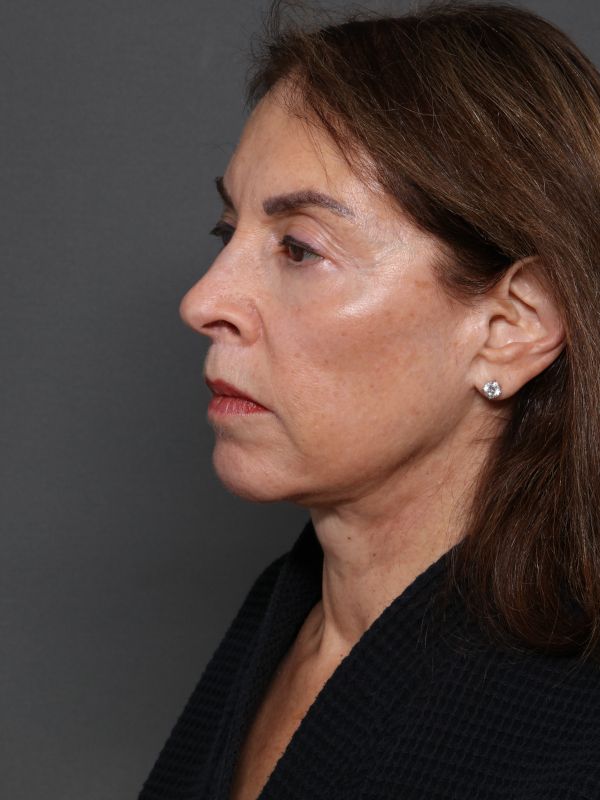 Facelift Before & After Image