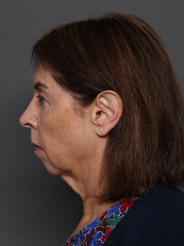 Facelift Before & After Image