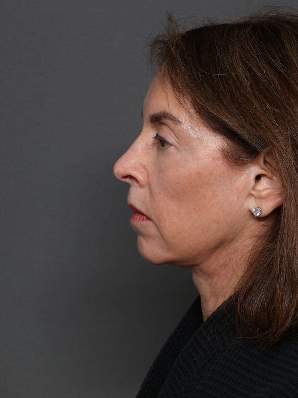 Facelift Before & After Image