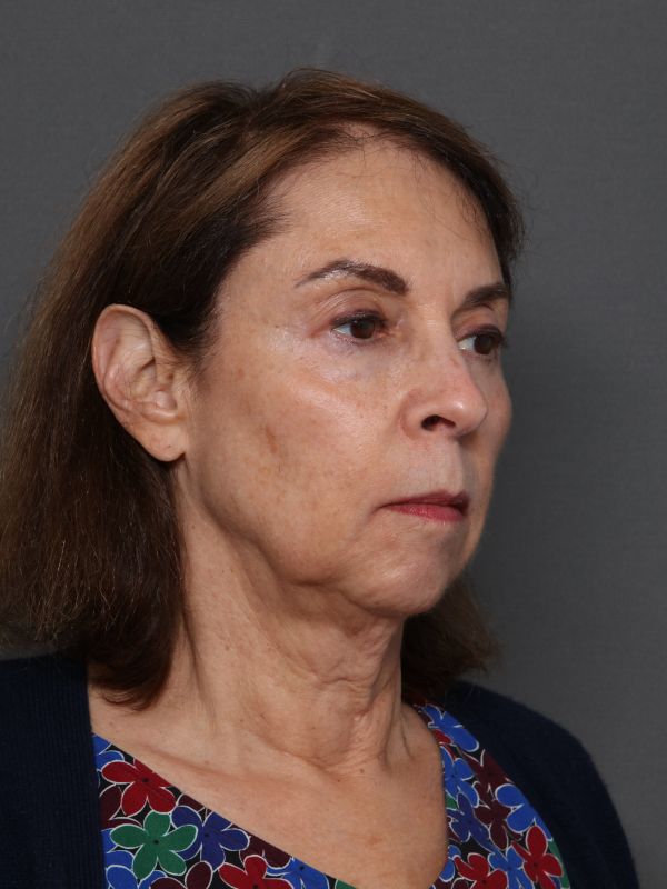 Facelift Before & After Image