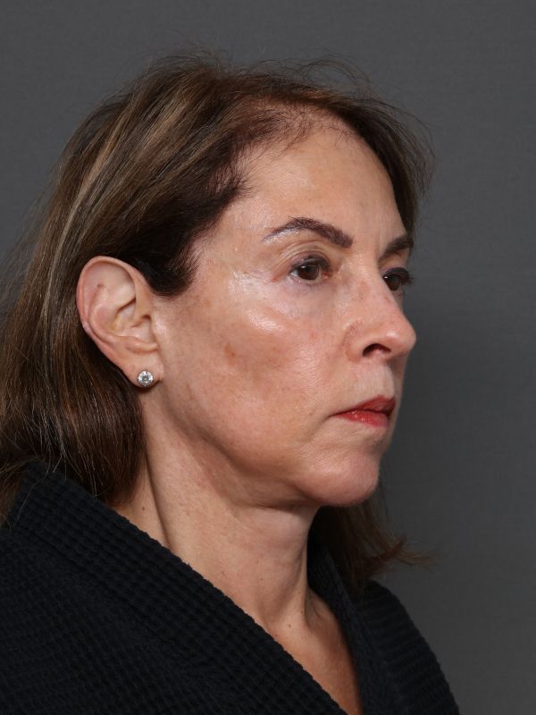 Facelift Before & After Image