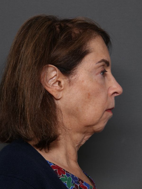 Facelift Before & After Image